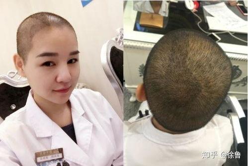 女性秃顶图片,揭秘现代女性脱发之谜